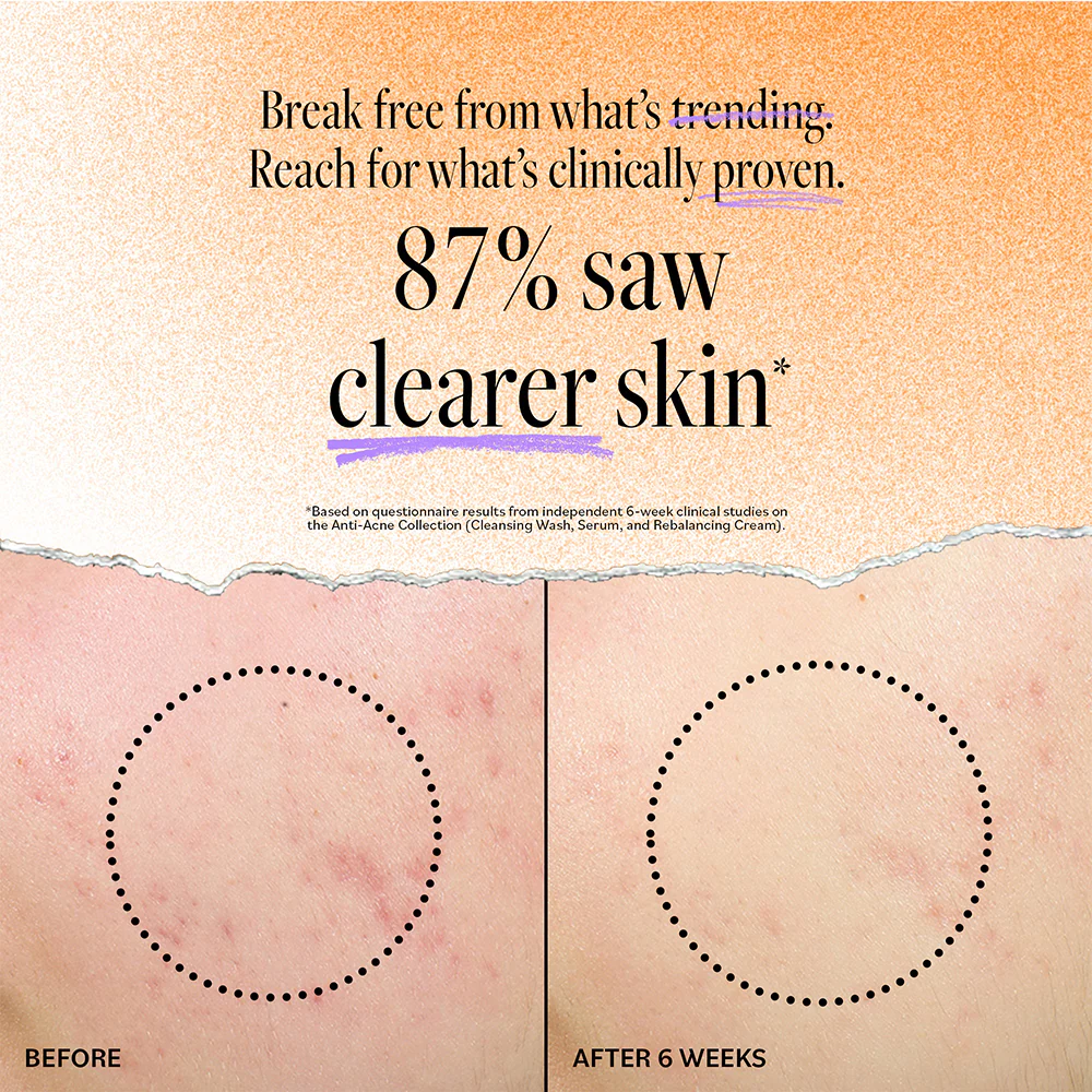 Acne Deep Pore Cleansing Wash - Image 3