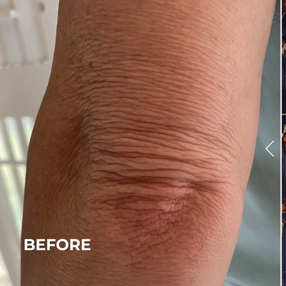Crepey Skin Repair Treatment - Image 3