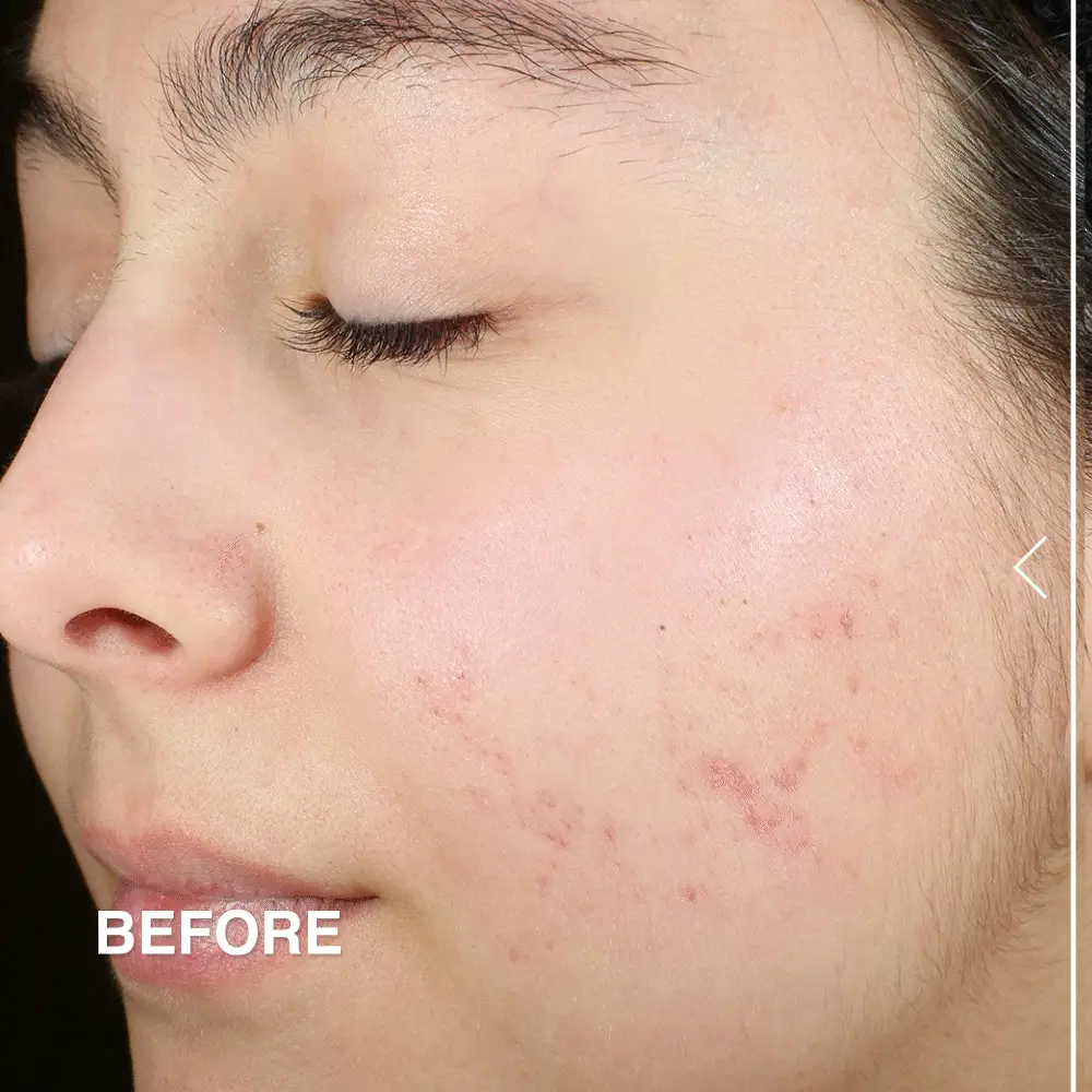 Sulfur Spot Treatment - Image 3